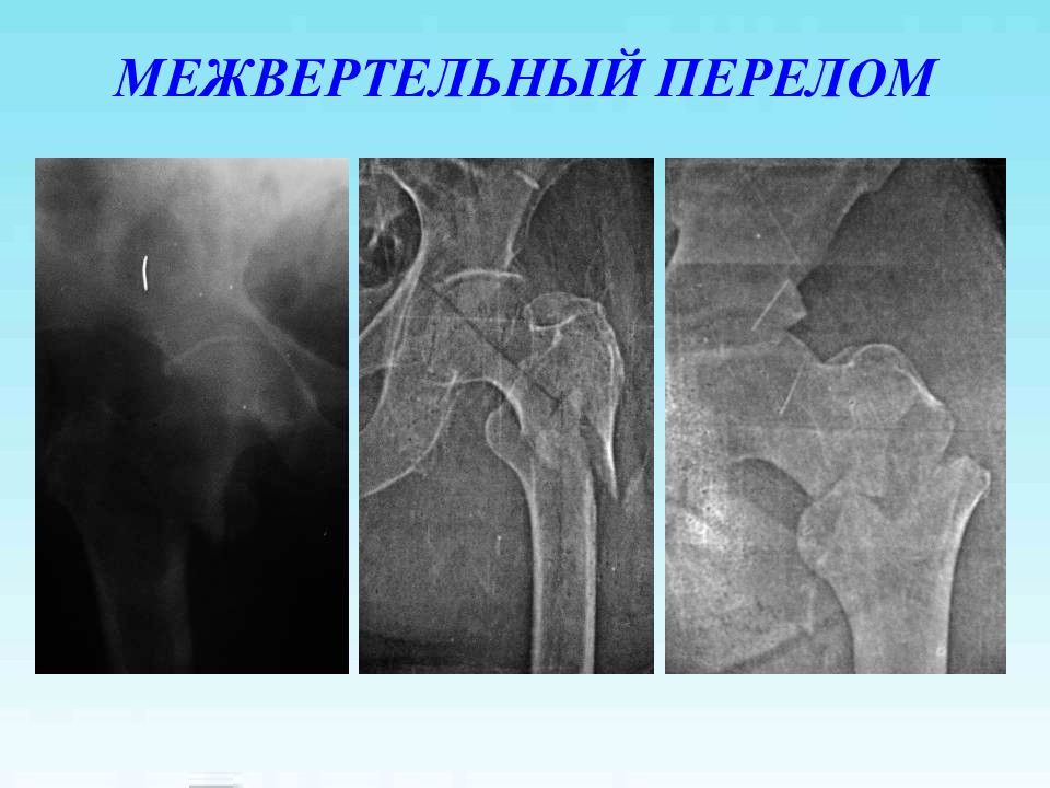 Через бедренный перелом. Межвертельный перелом шейки бедра рентген. Перелом бедренной кости рентген. Чрезвертельный перелом правой бедренной кости. Межвертельный перелом бедренной кости со смещением рентген.