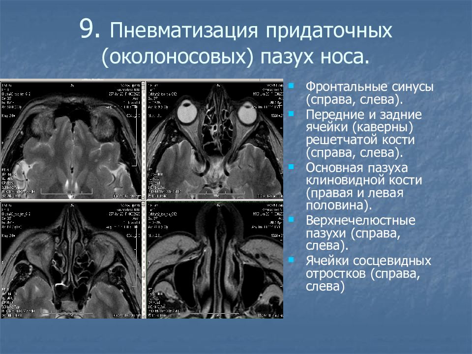 Пневматизация. Гиперпневматизация основной пазухи. Придаточные пазухи носа пневматизированы. Пневматизация основной пазухи. Пневматизация придаточных пазух.