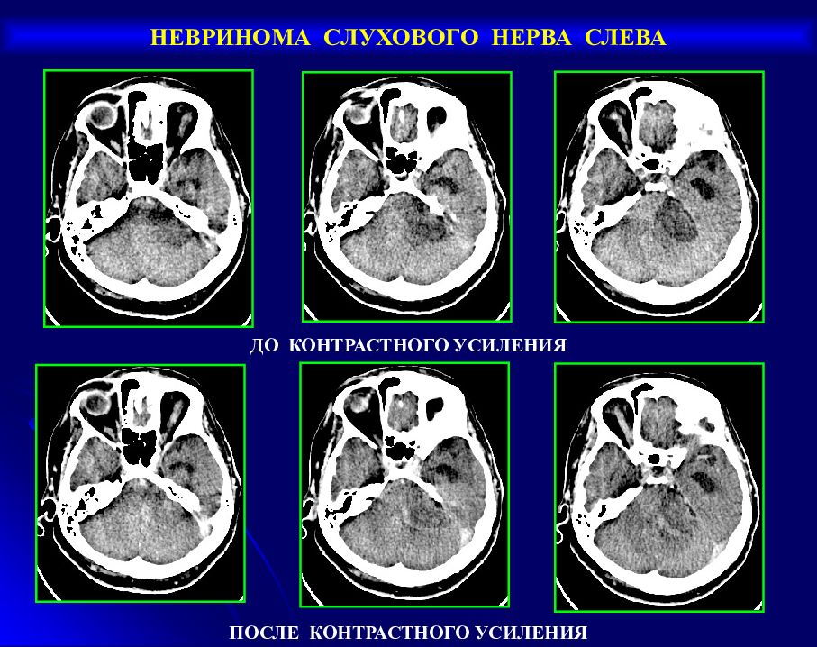 Невринома слухового нерва презентация