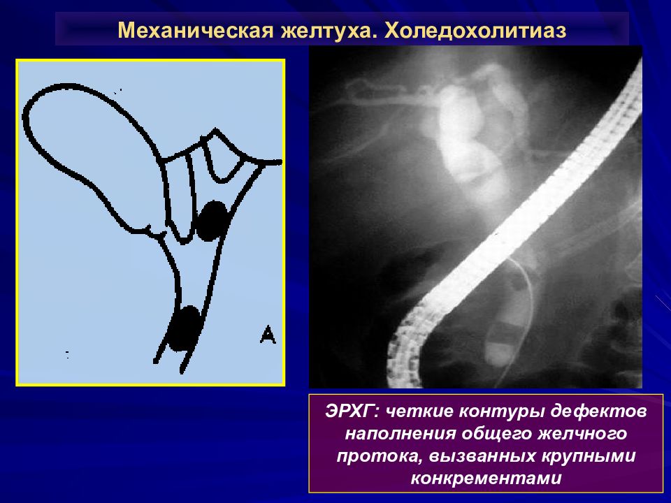 Механическая желтуха презентация по хирургии
