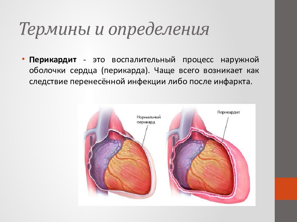 Жидкость в перикарде сердца