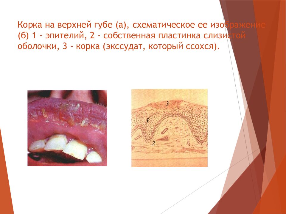 Корка на верхней губе (а), схематическое ее изображение (б) 1 - эпителий, 2 - собственная пластинка слизистой оболочки, 3 - корка (экссудат, который ссохся).