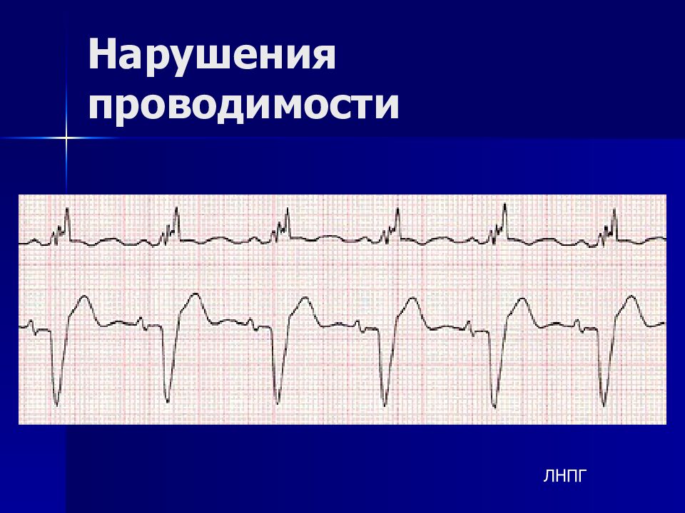 Экг при нарушениях ритма и проводимости презентация