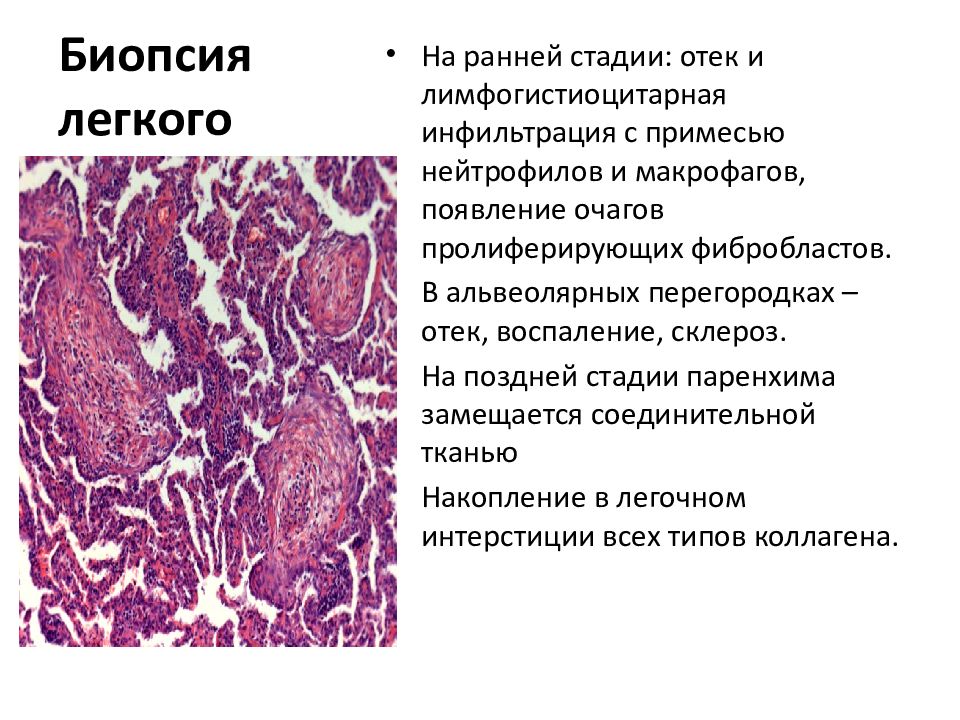 Биопсия легких. Лимфогистиоцитарная инфильтрация. Лимфогистмоцмтарная инфмлтипация. Лимфо-гистиоцитарная инфильтрация что это. Очаговая лимфогистиоцитарная инфильтрация.