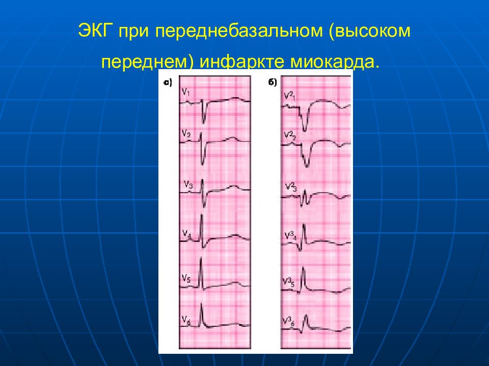 Как выглядит инфаркт на экг картинки и фото