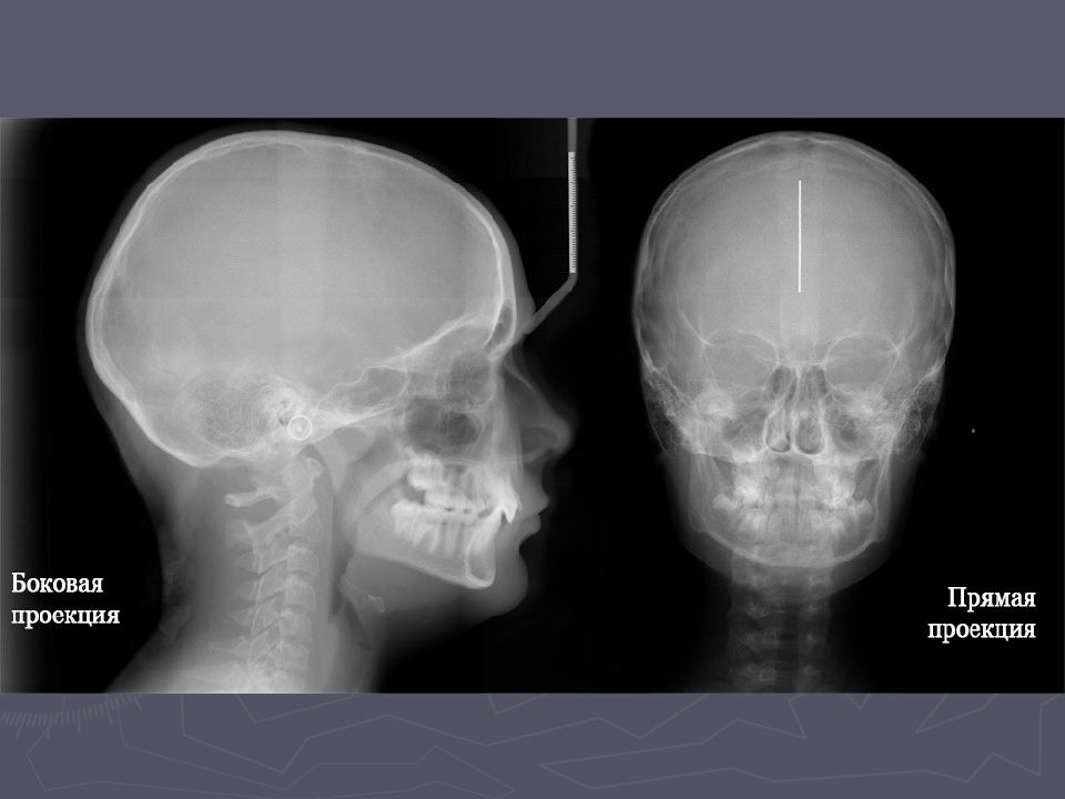Рентгенография 2 х проекциях. Рентген костей черепа в 2 проекциях. Кости черепа рентген норма. ТРГ черепа в прямой проекции.