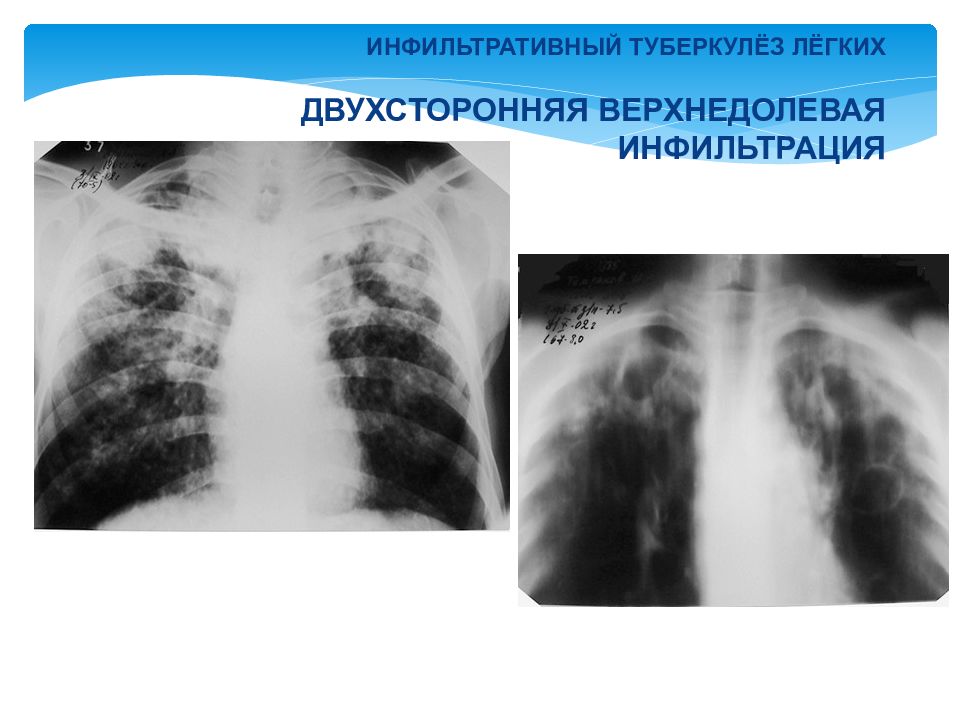 Верхнедолевая пневмония. Очаговый и инфильтративный туберкулез легких. Очаговая верхнедолевая пневмония рентген. Инфильтративный и казеозный туберкулез. Туберкулезный инфильтрат и пневмония.