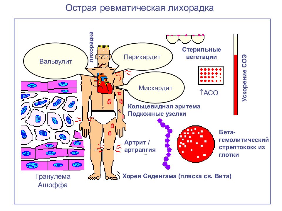 Острая ревматическая лихорадка у детей картинки