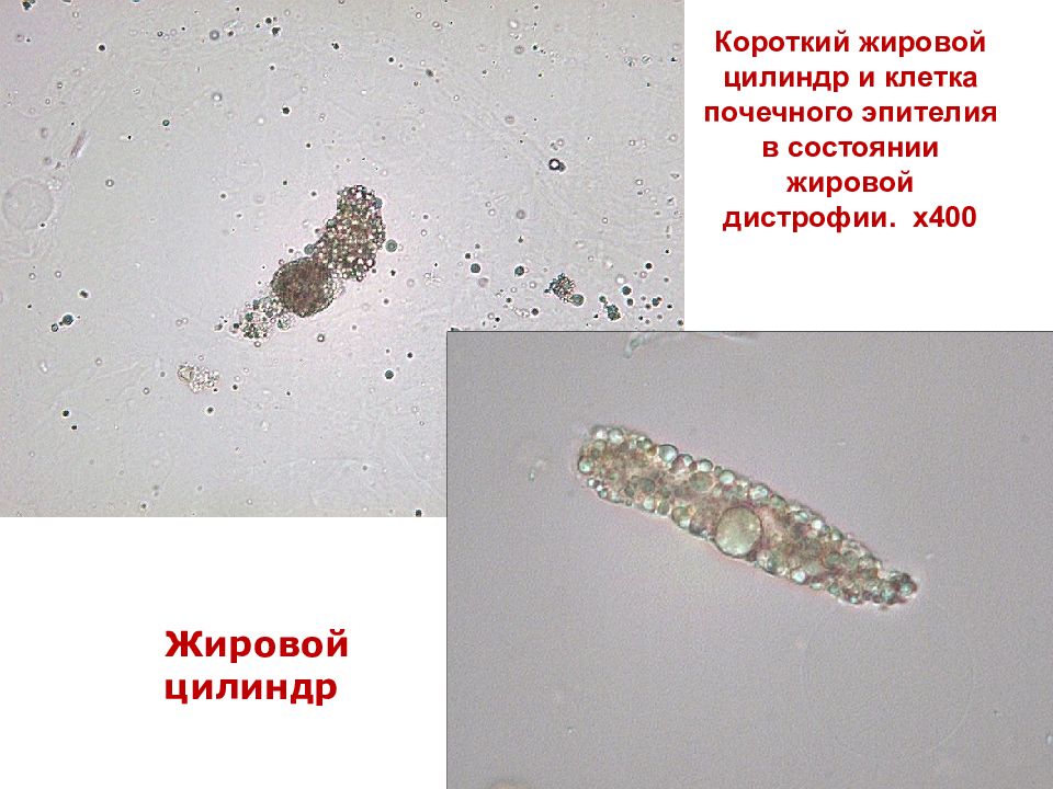 Жировой цилиндр в моче фото