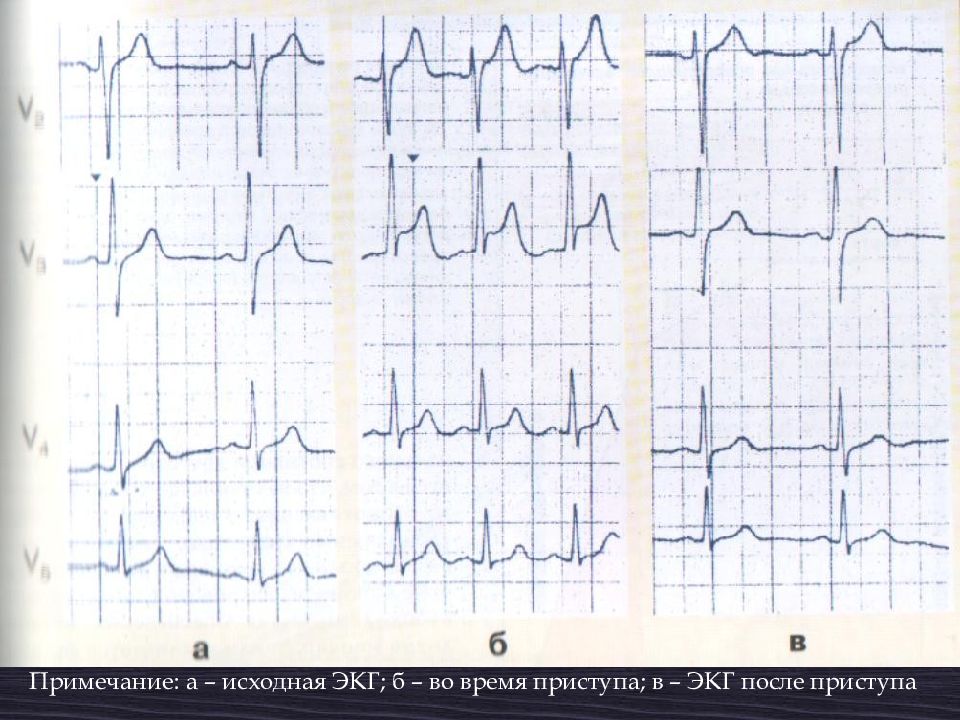 Экг после. ЭКГ после операции. ЭКГ во время приступа. Исходная кардиограмма. ЭКГ после болезни.