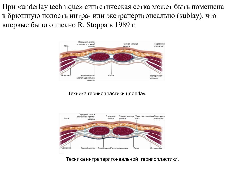 Грыжи передней брюшной стенки презентация