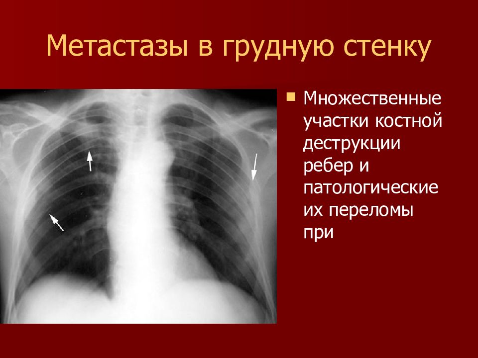 Метастазы в легких рентгенологическая картина