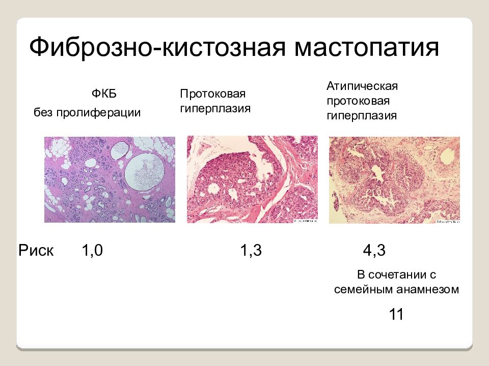 Диффузная молочная. Фиброзно-кистозная мастопатия молочной железы. Фиброзно-кистозная ткань молочной железы. Фиброзно-кистозная мастопатия гистология. Фиброкистозная мастопатия молочной железы микропрепарат.