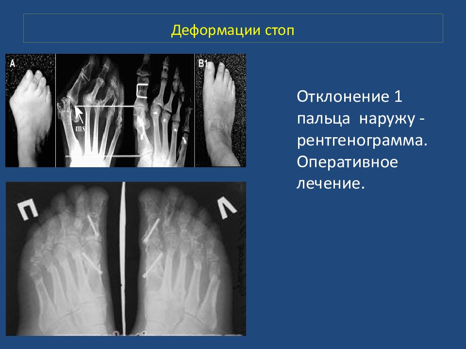 Деформации стоп презентация