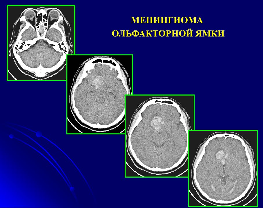 Менингиома на кт. Опухоль головного мозга ольфакторной ямки. Менингиома головного мозга кт. Менингиома ольфакторной ямки кт.