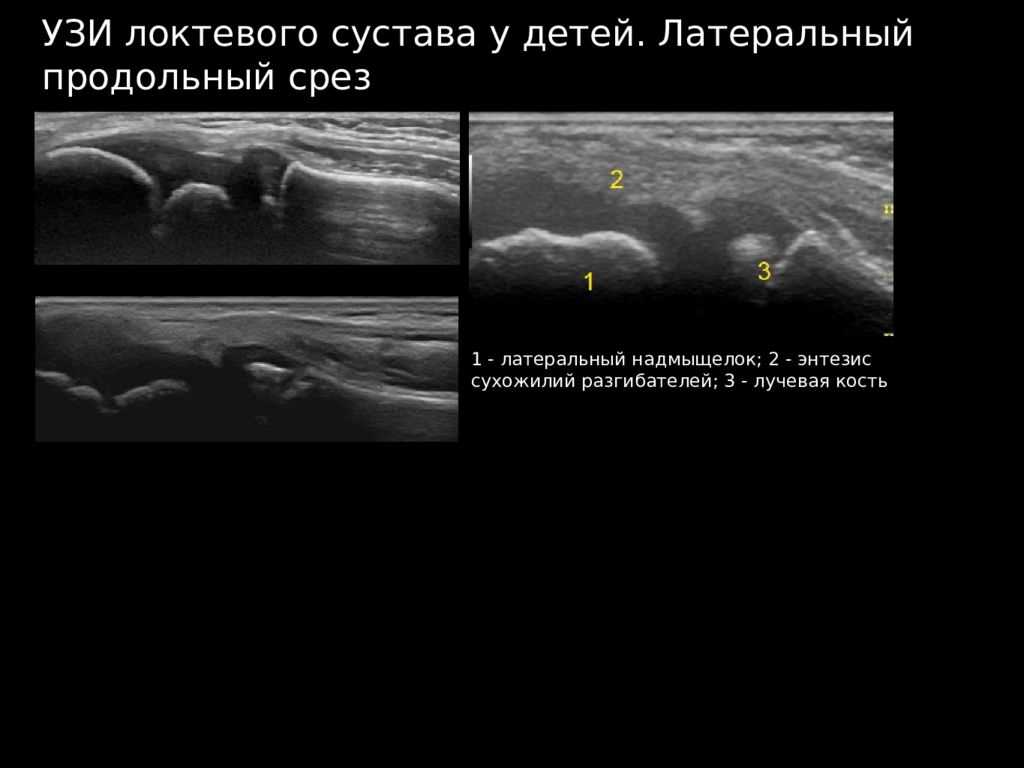 Протокол узи локтевого сустава образец