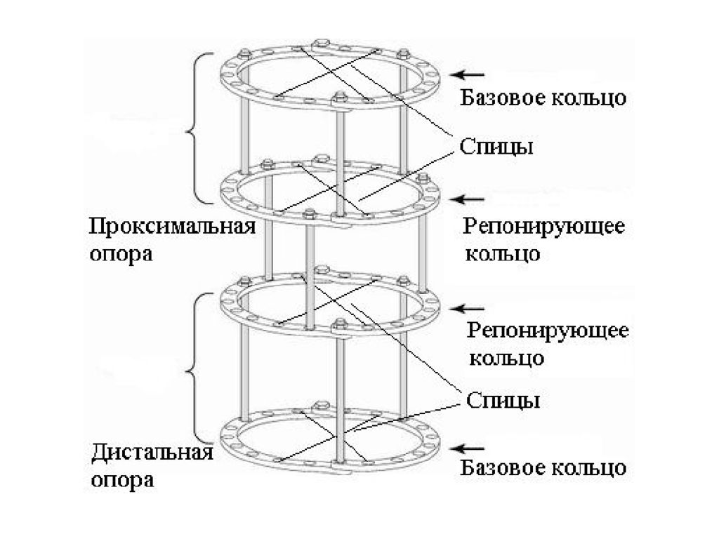 Аппарат илизарова презентация