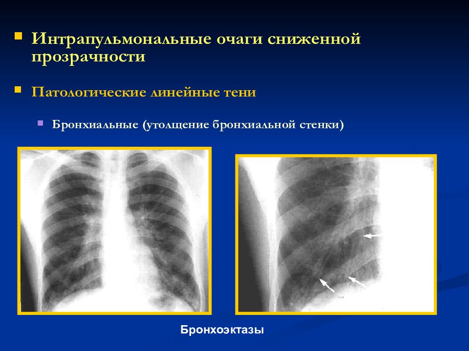 Стенки бронхов утолщены