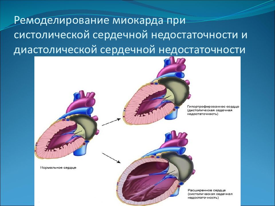 Миокардиальная сердечная недостаточность. Пусковые факторы ремоделирования миокарда. Клинико-лабораторные проявления ремоделирования миокарда. Ремоделирование сердца патофизиология. Ремоделирование миокарда левого желудочка.