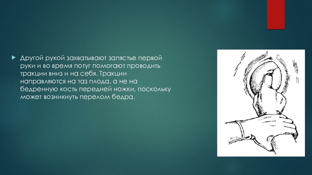 Процесс плод за плодом снимаем дивный 7. Извлечение плода за тазовый конец. Извлечение плода за тазовый конец подготовка. Тракция плода за тазовый конец техника.