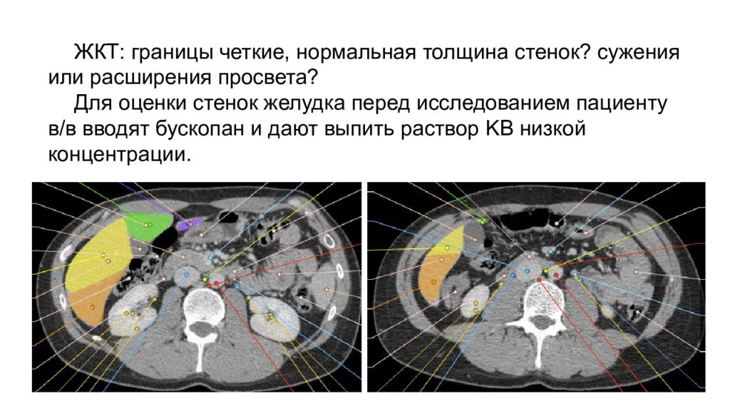 Как часто можно кт. Интегралы в компьютерной томографии. Нормальная толщина стенки желудка. Толщина стенок желудка на кт. Толщина стенки желудка по кт.