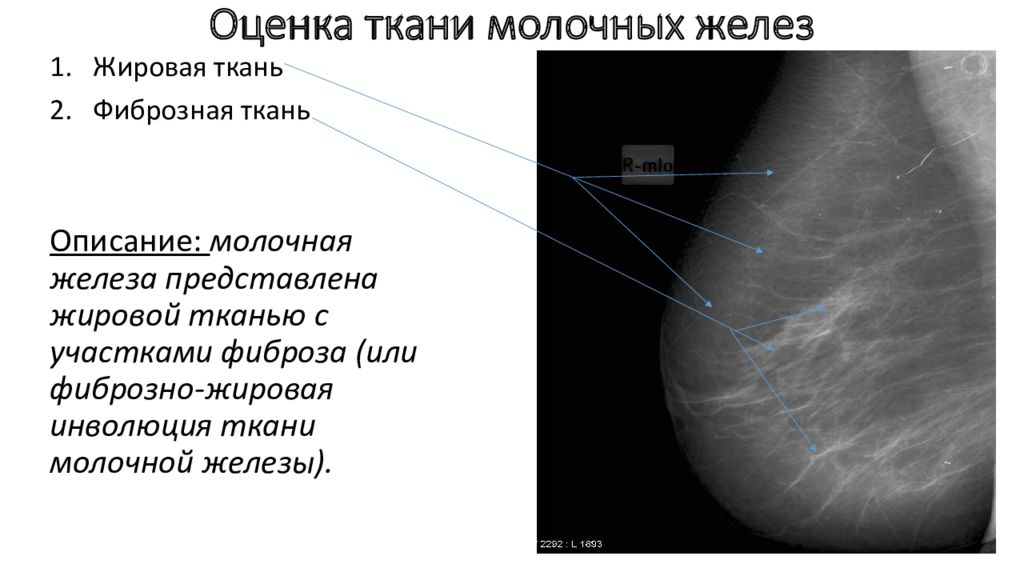 Маммография ответы. Локальный фиброз молочной железы на УЗИ. Жировая инволюция маммограммы. Анатомия молочной железы маммограмма. Галактоцеле молочной железы маммография.