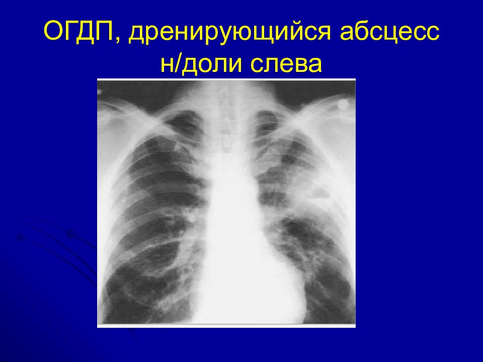 Острая гнойная деструктивная пневмония у детей презентация