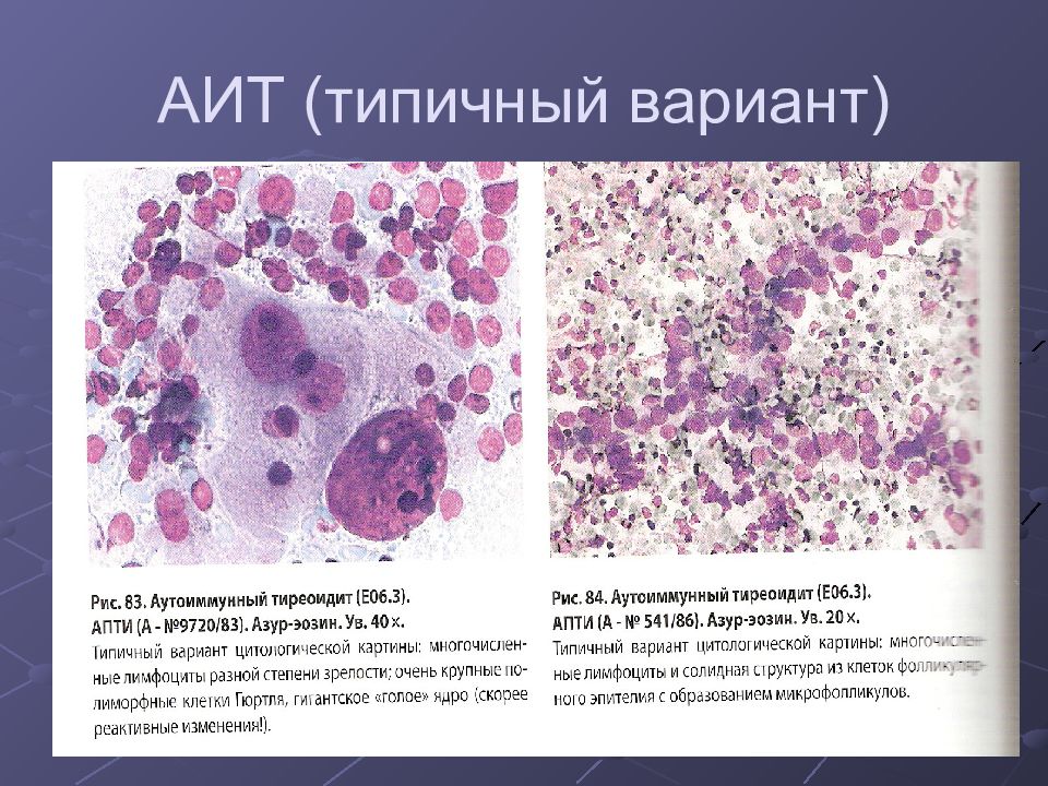 Цитологическая картина коллоидного узла щитовидки