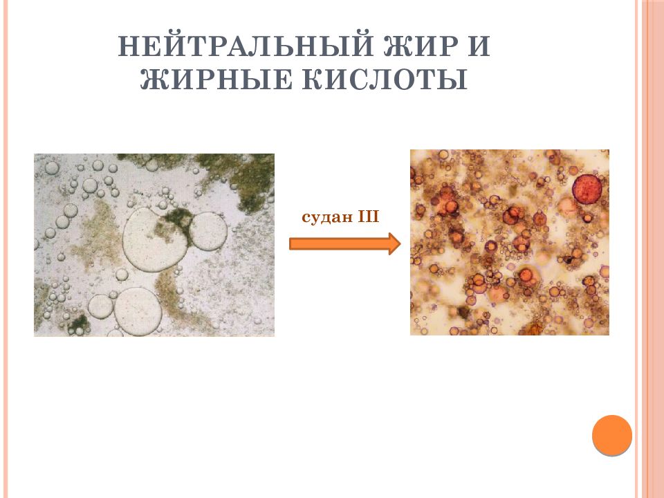 Жирные кислоты в кале. Копрология нейтральный жир. Нейтральный жир и жирные кислоты. Нейтральный жир и жирные кислоты в Кале. Микроскопия кала нейтральный жир.