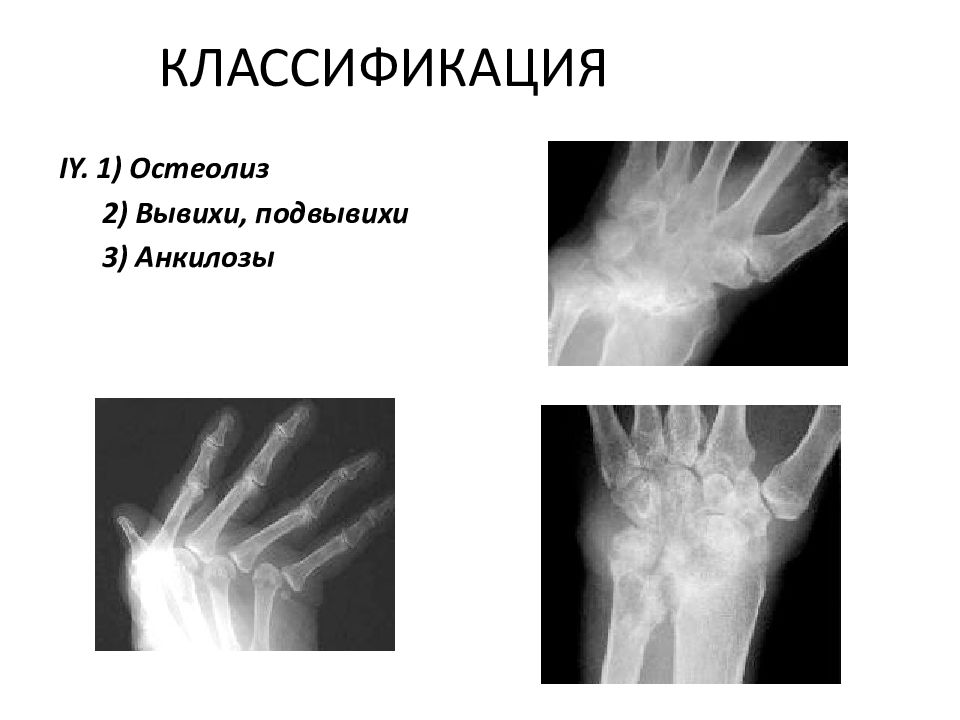 Остеолиз это. Анкилоз лучезапястного сустава. Подвывих лучезапястного сустава. Подвывих при ревматоидном артрите.