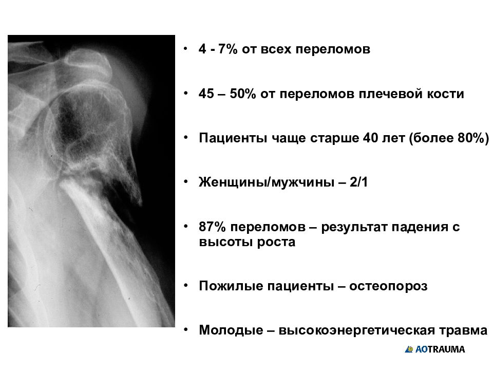 Переломы плечевой кости презентация