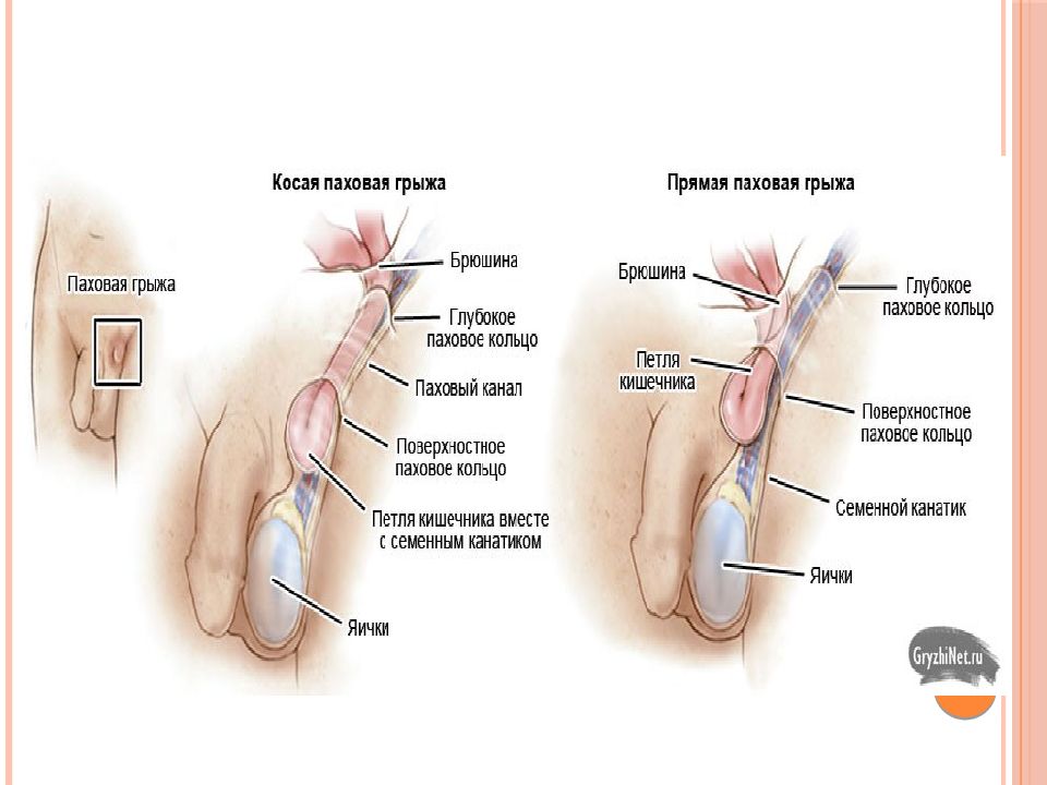 Паховая грыжа рисунок