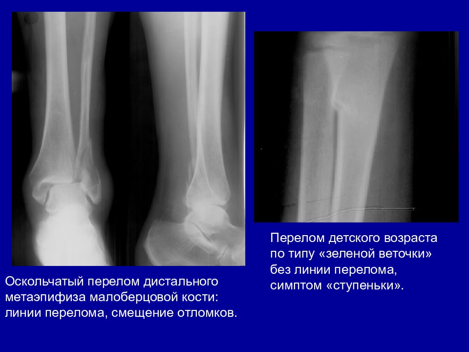 Дистальной трети диафиза. Перелом дистального метаэпифиза малоберцовой кости. Перелом нижней трети малоберцовой кости голени. Перелом латеральной лодыжки малоберцовой кости без смещения отломка. Перелом берцовой кости рентген.