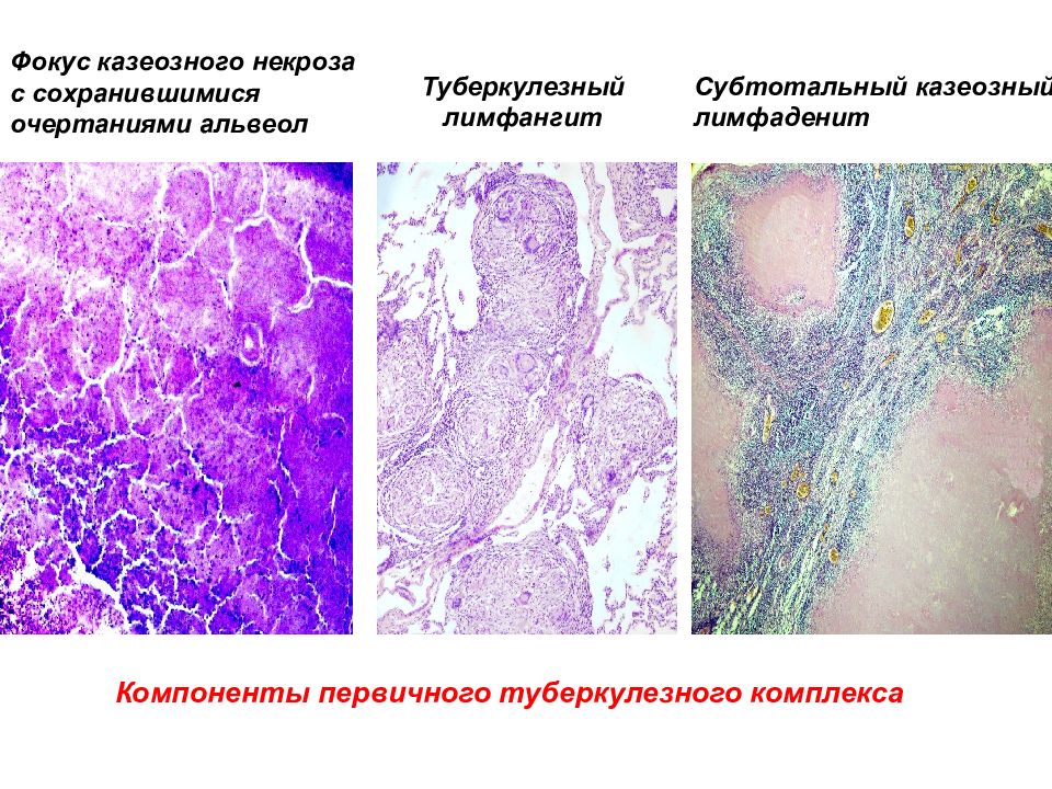 Туберкулезді лимфаденит презентация