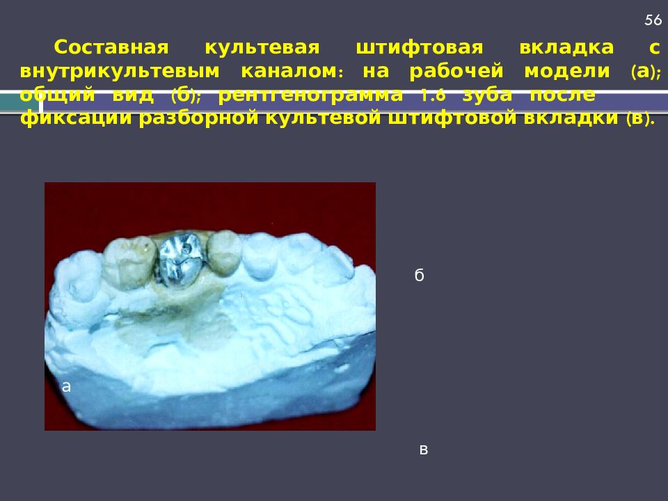 Составная культевая штифтовая вкладка с внутрикультевым каналом: на рабочей модели (а); общий вид (б); рентгенограмма 1.6 зуба после фиксации разборной