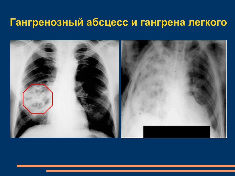 Гангрена легкого. Гангренозный абсцесс легкого. Гангренозный абсцесс рентген. Гангрена легкого на рентгенограмме. Рентгенограмма при гангрене легкого.