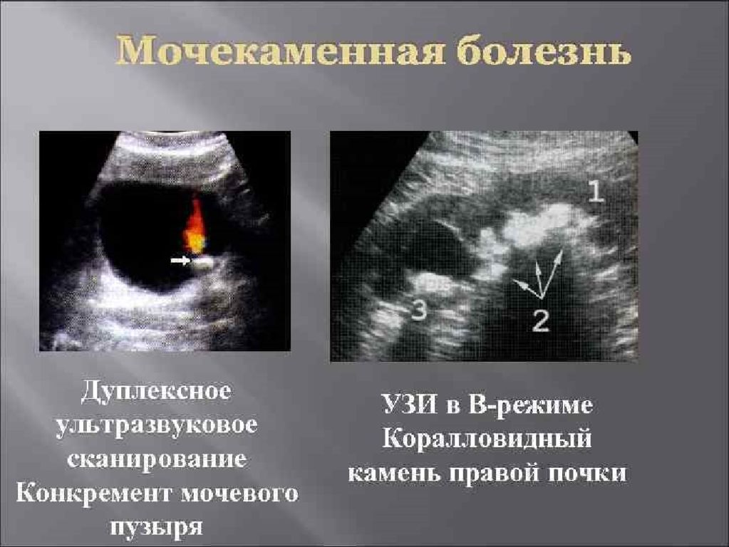 Камни на узи не видны. Коралловидный камень в почке УЗИ. Мочекаменная болезнь УЗИ. УЗИ органов мочевыделительной системы. Мочекаменная болезнь УЗИ почек.