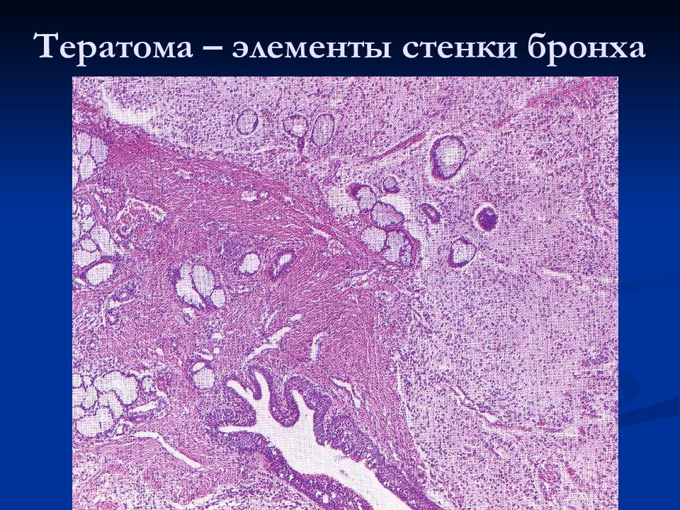 Мезенхимальные опухоли патологическая анатомия презентация