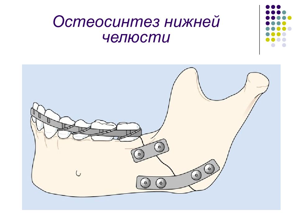 При переломе челюсти шинирование схема