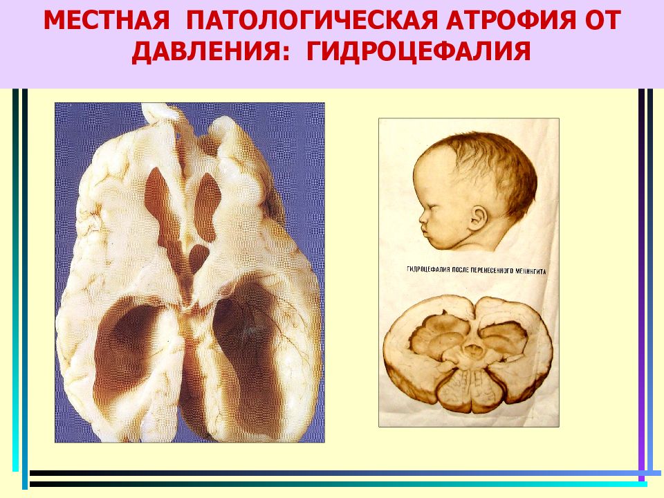 Атрофия головного мозга степени. Гидроцефалия патологическая анатомия. Патологическая атрофия. Патологическая местная атрофия. Атрофическая гидроцефалия.