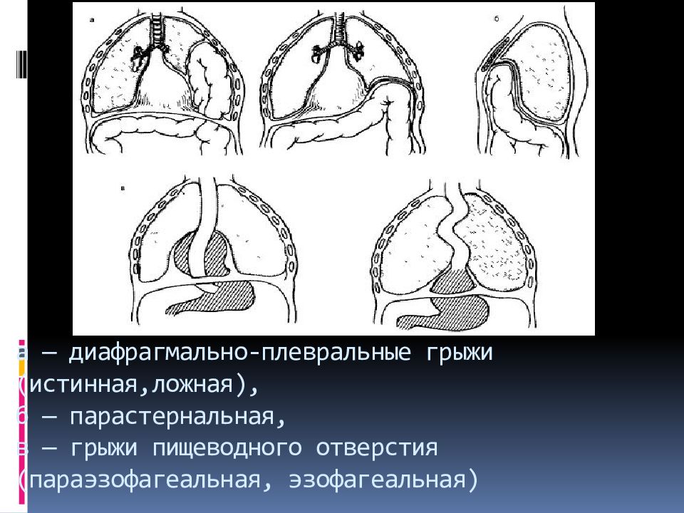 Диафрагмальная грыжа презентация хирургия