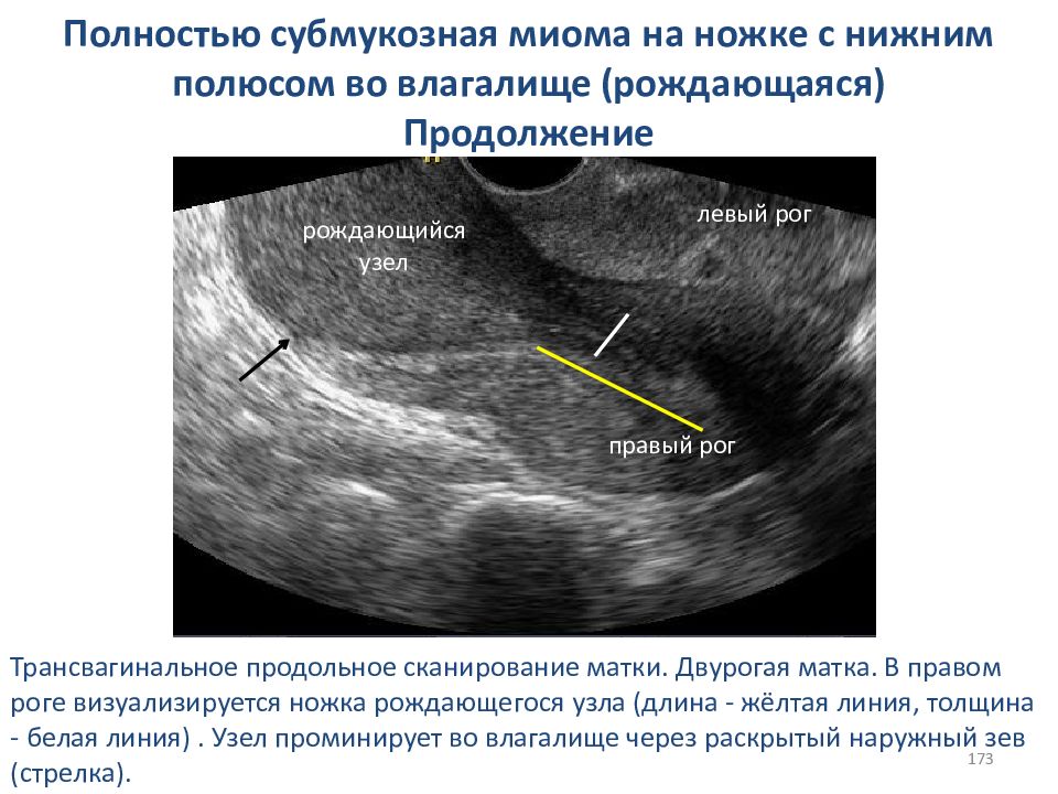 Узелок в матке. Рождение субмукозного миоматозного узла. Рождающийся миоматозный узел на УЗИ.