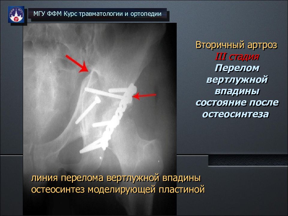 Задний край без смещения. Оскольчатый перелом вертлужной впадины. Краевой перелом вертлужной впадины рентген. Трансацетабулярный перелом вертлужной впадины. Закрытый оскольчатый перелом вертлужной впадины со смещением.