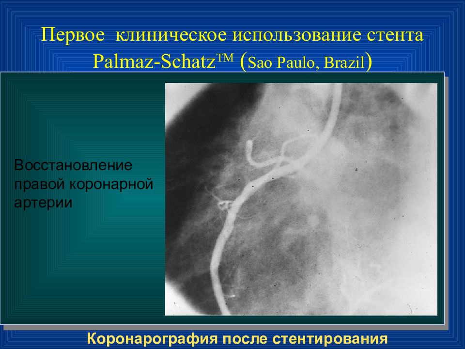 Перед коронарографией. Коронарография восстановление. Контрольная коронарография после стентирования. Коронарография антикоагулянты. Стент Palmaz.