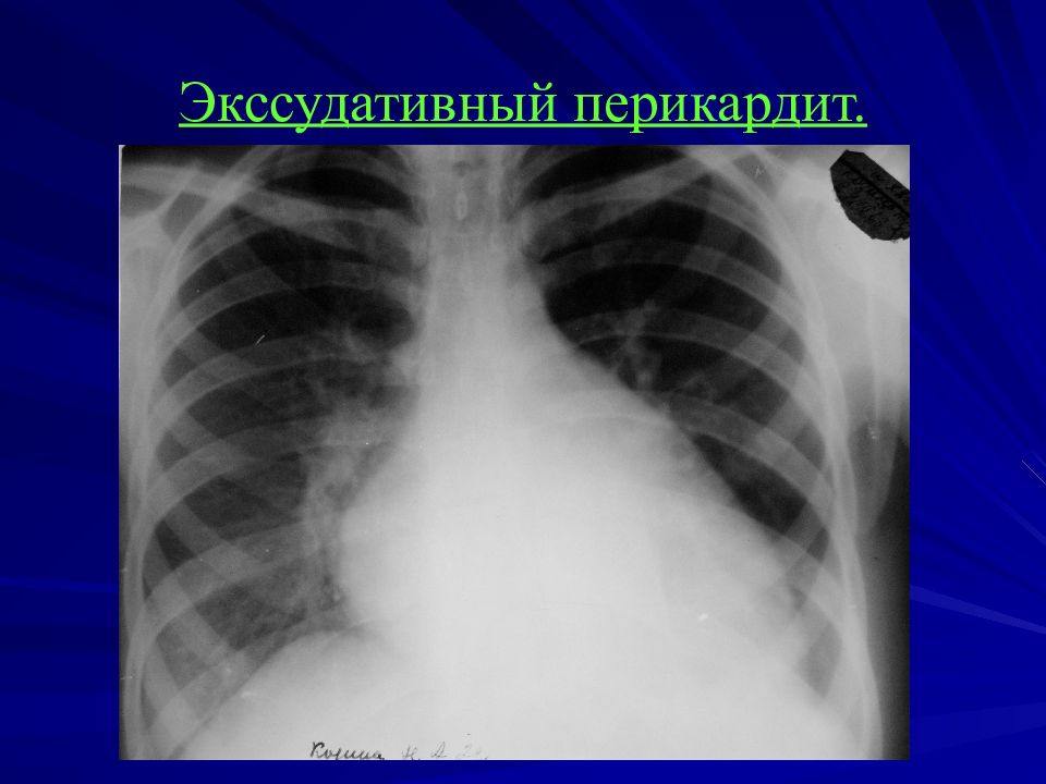 При выпотном перикардите на рентгенограмме наблюдается легочный рисунок тест ответ