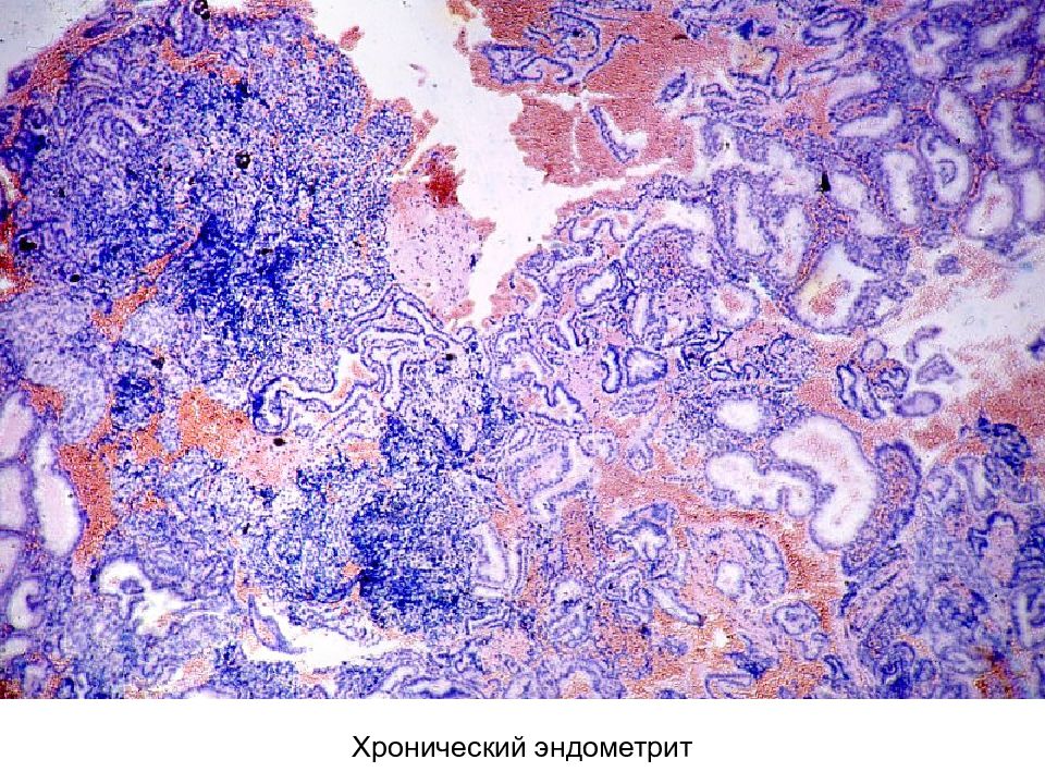 Септический эндометрит. Острый эндометрит гистология. Хронический эндометрит микропрепарат. Эндометрит микропрепарат. Гнойный эндометрит патанатомия макропрепарат.