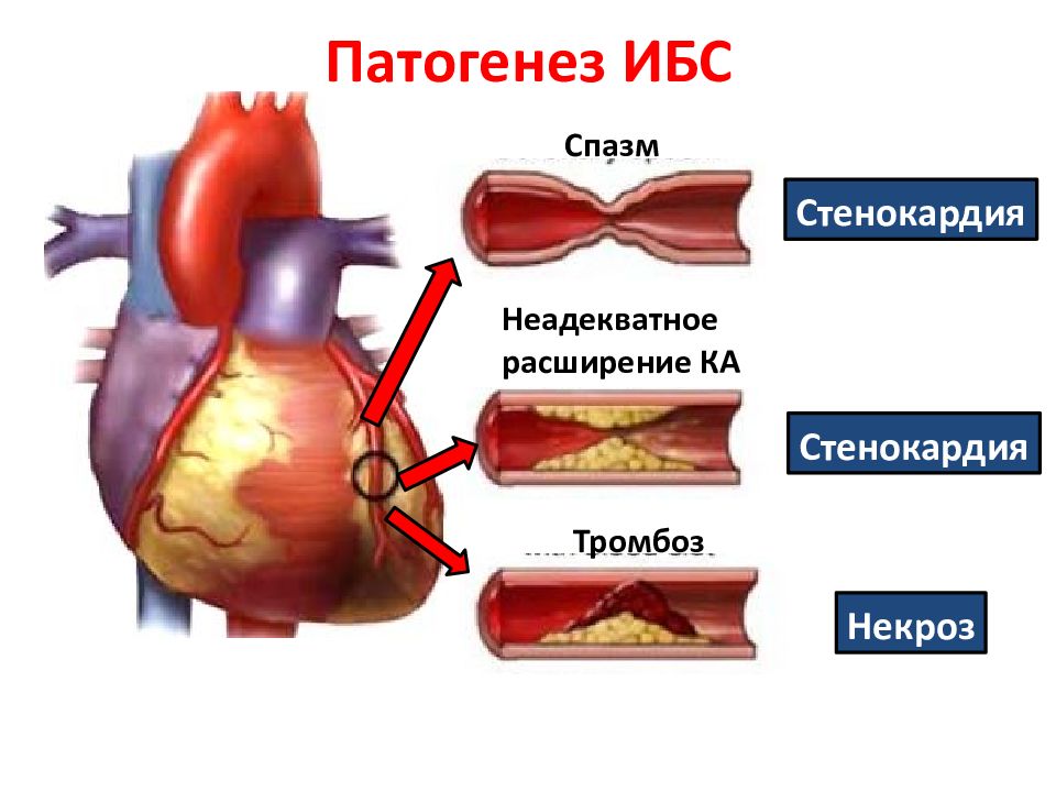 Ишемия боковой стенки. Ишемическая болезнь сердца стенокардия. Патогенетические факторы ишемической болезни сердца. Ишемическая болезнь сердца механизм развития. Ишемическая болезнь сердца этиология и патогенез.