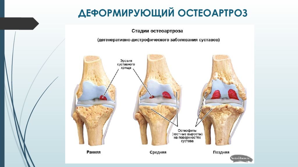 Остеоартроз это. .Деформирующий остеоартрит остеоартроз. Деформирующий артроз (остеоартроз). Деформирующий артроз коленного сустава схема. Причины развития деформирующего остеоартроза.