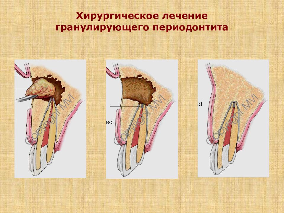 Хирургическое лечение периодонтитов презентация