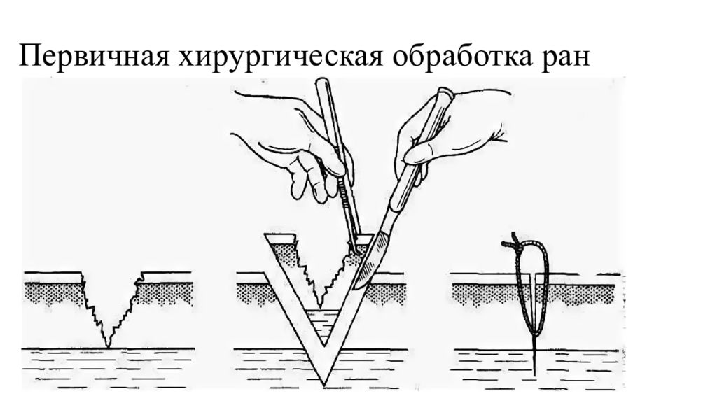 Первичная хирургическая обработка ран